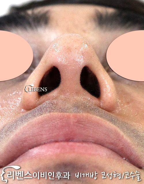 뾰족한 코끝 매부리코 메부리코 성형 수술 교정 외국인 무보형물 절골 성형 s594